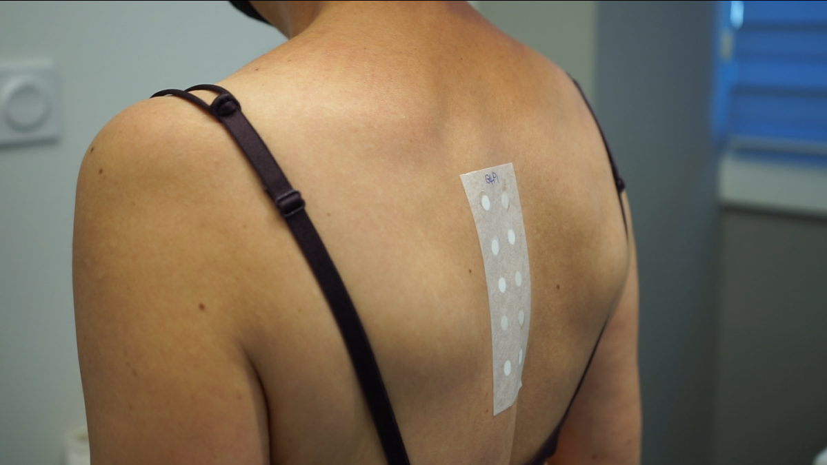Un patch test appliqué sur le dos d'une femme
